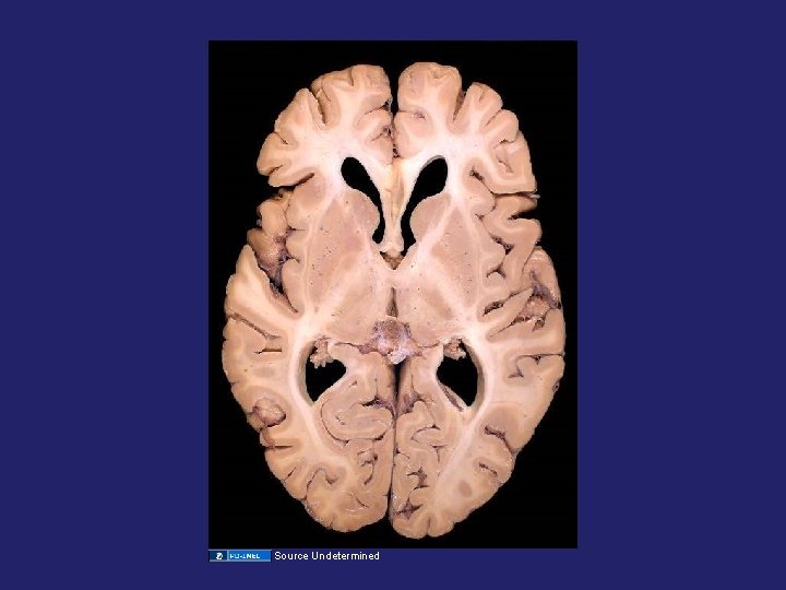 Source Undetermined Source Undetermined