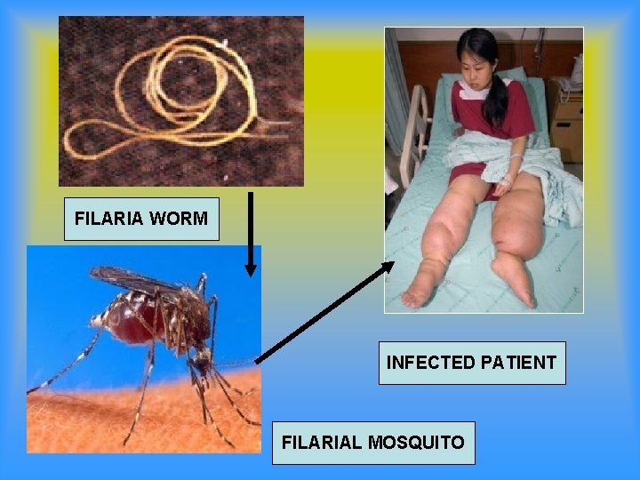 FILARIA WORM INFECTED PATIENT FILARIAL MOSQUITO 