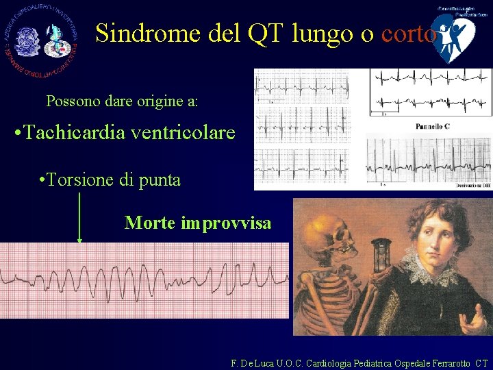 Sindrome del QT lungo o corto Possono dare origine a: • Tachicardia ventricolare •