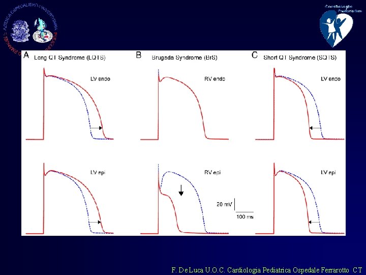 F. De Luca U. O. C. Cardiologia Pediatrica Ospedale Ferrarotto CT 