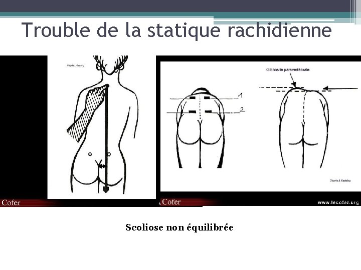 Trouble de la statique rachidienne Scoliose non équilibrée 