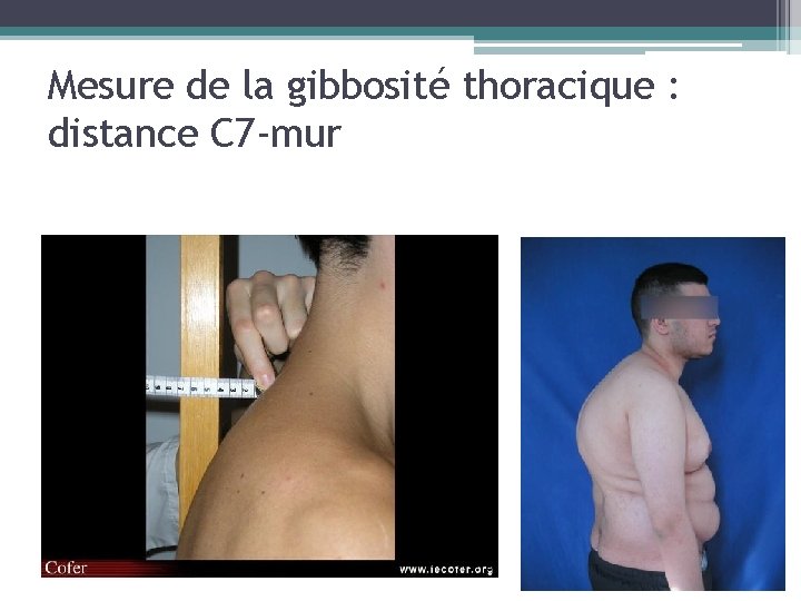 Mesure de la gibbosité thoracique : distance C 7 -mur 