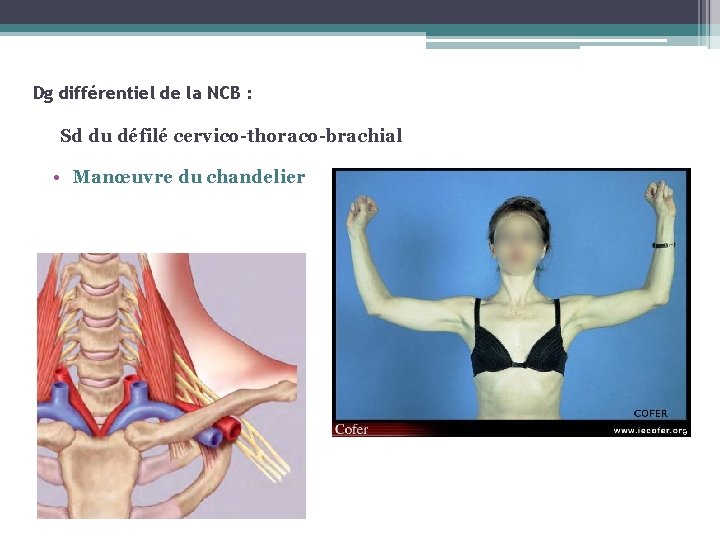Dg différentiel de la NCB : Sd du défilé cervico-thoraco-brachial • Manœuvre du chandelier