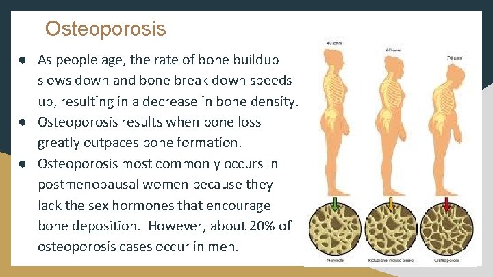 Osteoporosis ● As people age, the rate of bone buildup slows down and bone