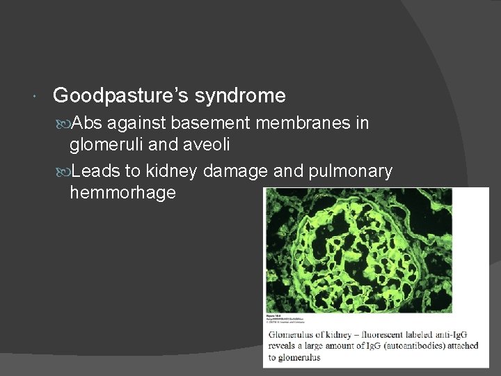  Goodpasture’s syndrome Abs against basement membranes in glomeruli and aveoli Leads to kidney