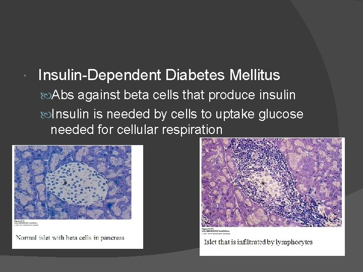  Insulin-Dependent Diabetes Mellitus Abs against beta cells that produce insulin Insulin is needed