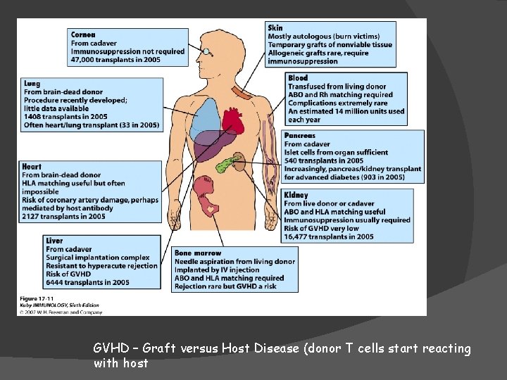 GVHD – Graft versus Host Disease (donor T cells start reacting with host 