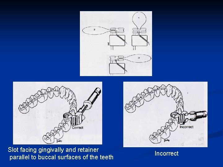 Slot facing gingivally and retainer parallel to buccal surfaces of the teeth Incorrect 