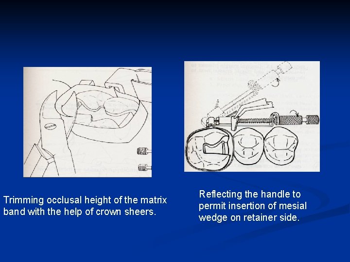 Trimming occlusal height of the matrix band with the help of crown sheers. Reflecting