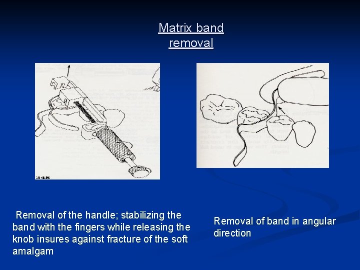 Matrix band removal Removal of the handle; stabilizing the band with the fingers while