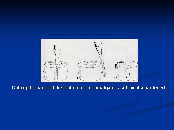 Cutting the band off the tooth after the amalgam is sufficiently hardened 