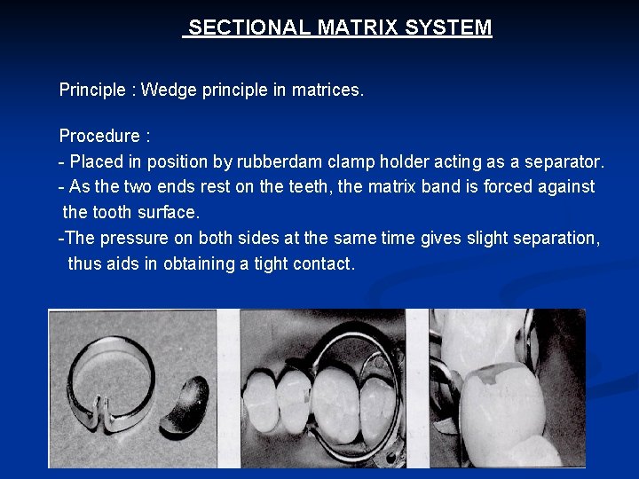 SECTIONAL MATRIX SYSTEM Principle : Wedge principle in matrices. Procedure : - Placed in