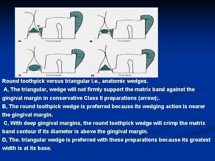 Round toothpick versus triangular i. e. , anatomic wedges. A, The triangular, wedge will