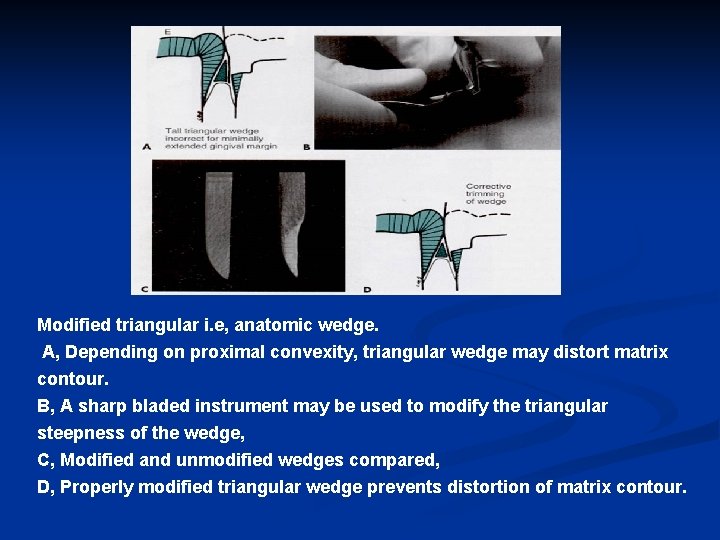 Modified triangular i. e, anatomic wedge. A, Depending on proximal convexity, triangular wedge may
