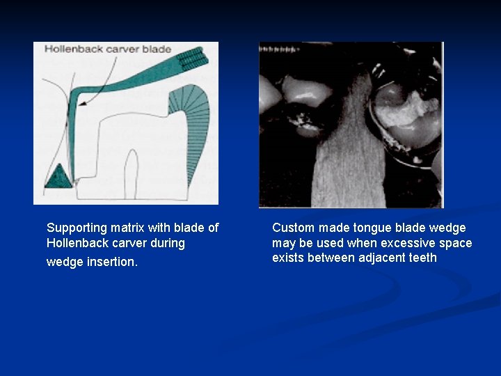 Supporting matrix with blade of Hollenback carver during wedge insertion. Custom made tongue blade