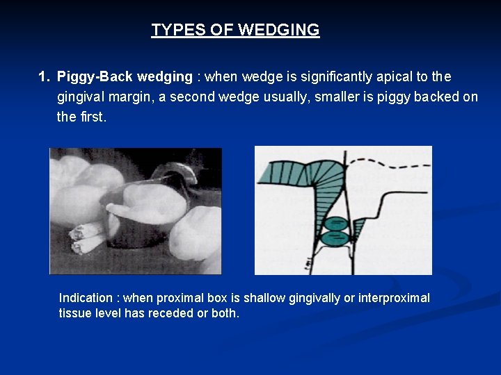 TYPES OF WEDGING 1. Piggy-Back wedging : when wedge is significantly apical to the