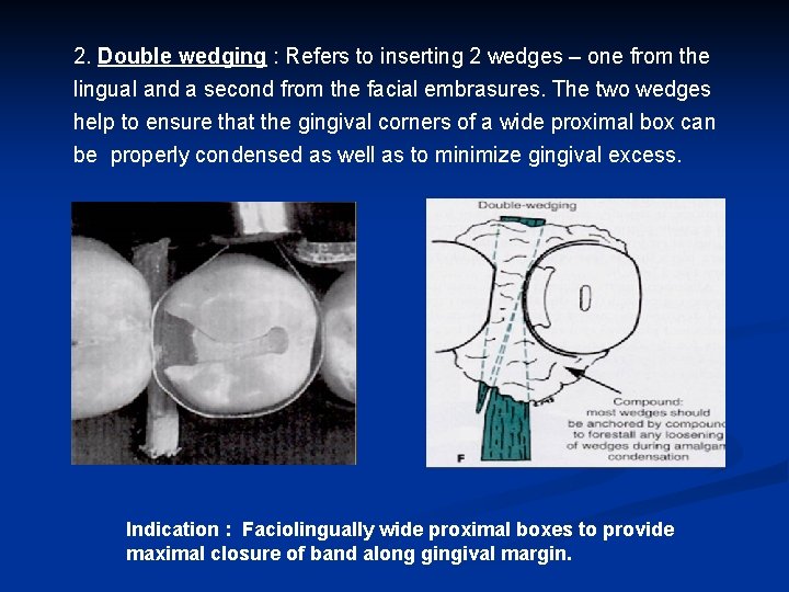 2. Double wedging : Refers to inserting 2 wedges – one from the lingual