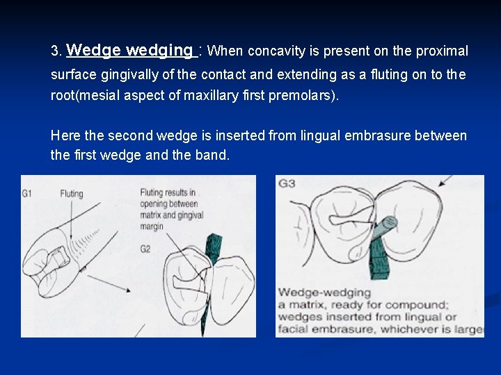 3. Wedge wedging : When concavity is present on the proximal surface gingivally of