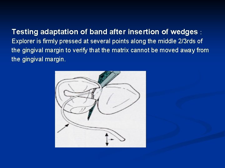 Testing adaptation of band after insertion of wedges : Explorer is firmly pressed at