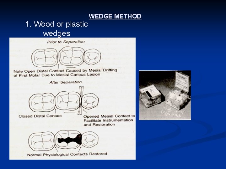 1. Wood or plastic wedges WEDGE METHOD 