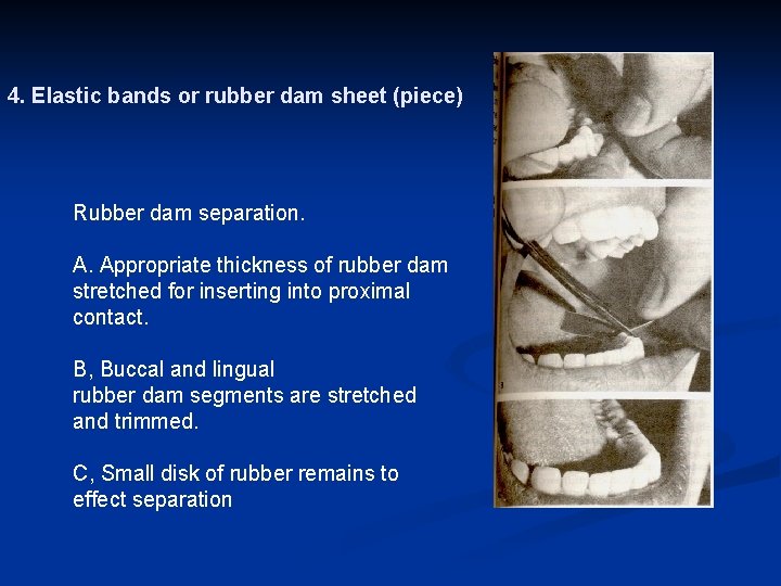 4. Elastic bands or rubber dam sheet (piece) Rubber dam separation. A. Appropriate thickness