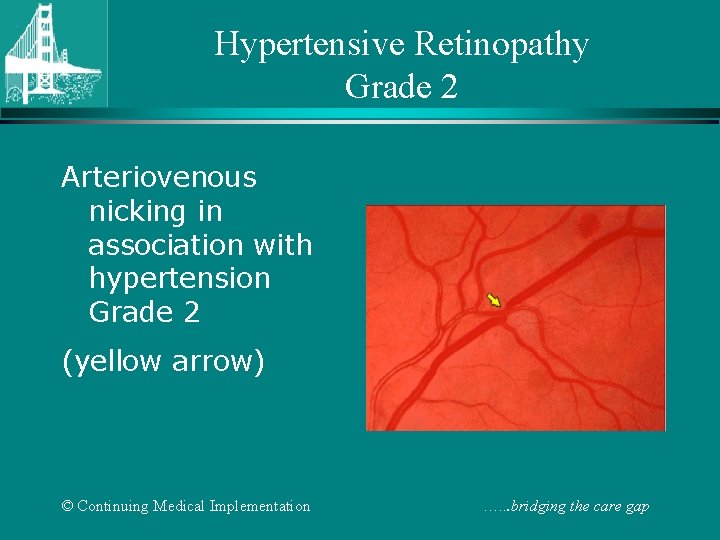 Hypertensive Retinopathy Grade 2 Arteriovenous nicking in association with hypertension Grade 2 (yellow arrow)
