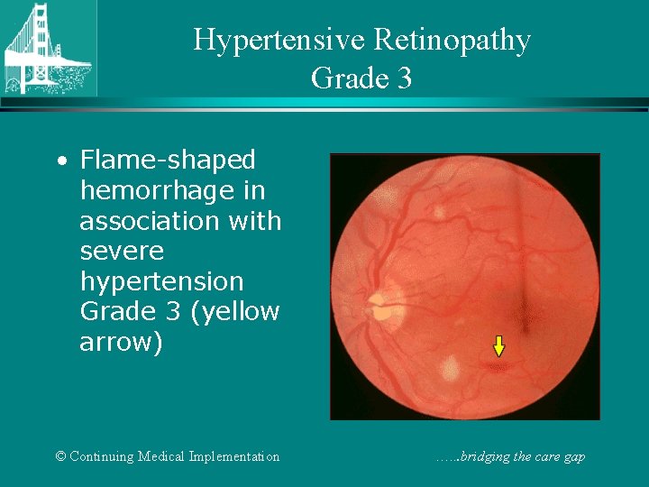 Hypertensive Retinopathy Grade 3 • Flame-shaped hemorrhage in association with severe hypertension Grade 3