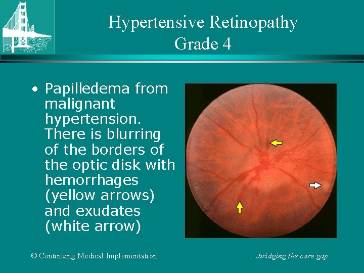 Hypertensive Retinopathy Grade 4 • Papilledema from malignant hypertension. There is blurring of the