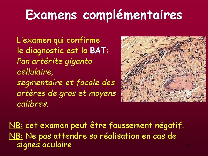 Examens complémentaires L’examen qui confirme le diagnostic est la BAT: Pan artérite giganto cellulaire, Examens complémentaires L’examen qui confirme le diagnostic est la BAT: Pan artérite giganto cellulaire,