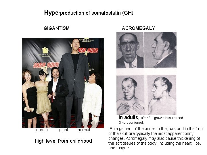 Hyperproduction of somatostatin (GH) GIGANTISM ACROMEGALY in adults, after full growth has ceased (Ill-proportioned,