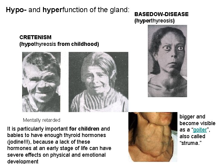 Hypo- and hyperfunction of the gland: BASEDOW-DISEASE (hyperthyreosis) CRETENISM (hypothyreosis from childhood) Mentally retarded