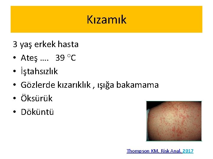 Kızamık 3 yaş erkek hasta • Ateş …. 39 C • İştahsızlık • Gözlerde Kızamık 3 yaş erkek hasta • Ateş …. 39 C • İştahsızlık • Gözlerde