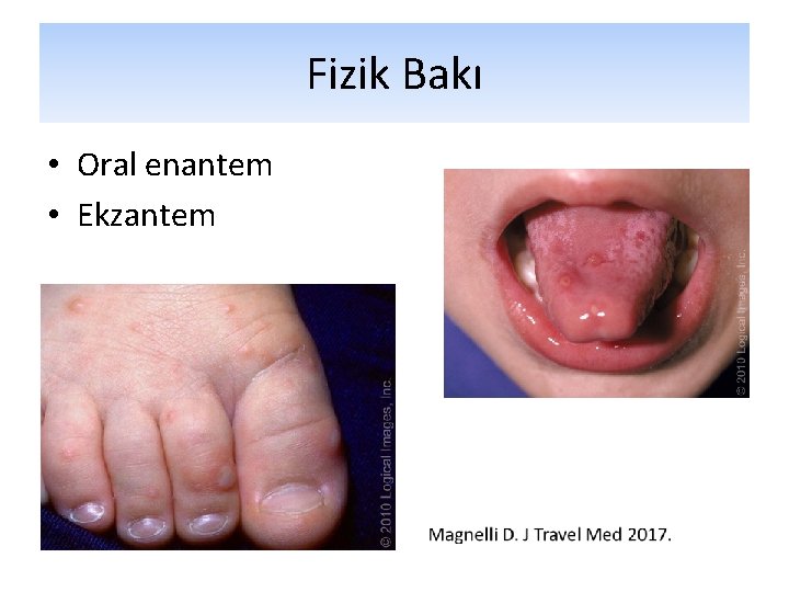 Fizik Bakı • Oral enantem • Ekzantem Fizik Bakı • Oral enantem • Ekzantem