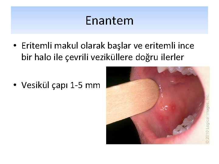 Enantem • Eritemli makul olarak başlar ve eritemli ince bir halo ile çevrili veziküllere Enantem • Eritemli makul olarak başlar ve eritemli ince bir halo ile çevrili veziküllere
