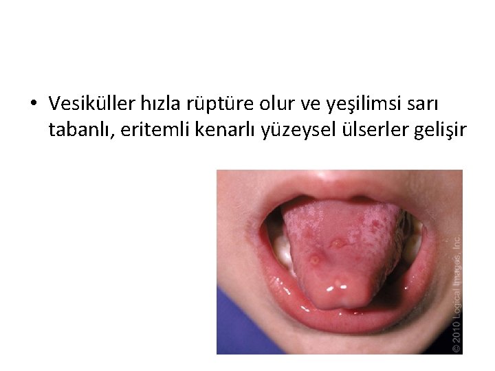 • Vesiküller hızla rüptüre olur ve yeşilimsi sarı tabanlı, eritemli kenarlı yüzeysel ülserler • Vesiküller hızla rüptüre olur ve yeşilimsi sarı tabanlı, eritemli kenarlı yüzeysel ülserler