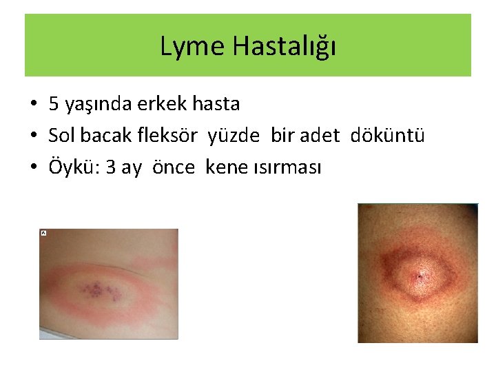 Lyme Hastalığı • 5 yaşında erkek hasta • Sol bacak fleksör yüzde bir adet Lyme Hastalığı • 5 yaşında erkek hasta • Sol bacak fleksör yüzde bir adet