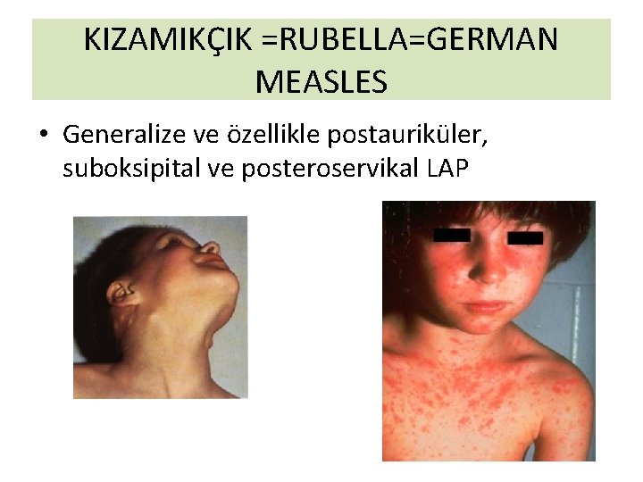 KIZAMIKÇIK =RUBELLA=GERMAN MEASLES • Generalize ve özellikle postauriküler, suboksipital ve posteroservikal LAP KIZAMIKÇIK =RUBELLA=GERMAN MEASLES • Generalize ve özellikle postauriküler, suboksipital ve posteroservikal LAP