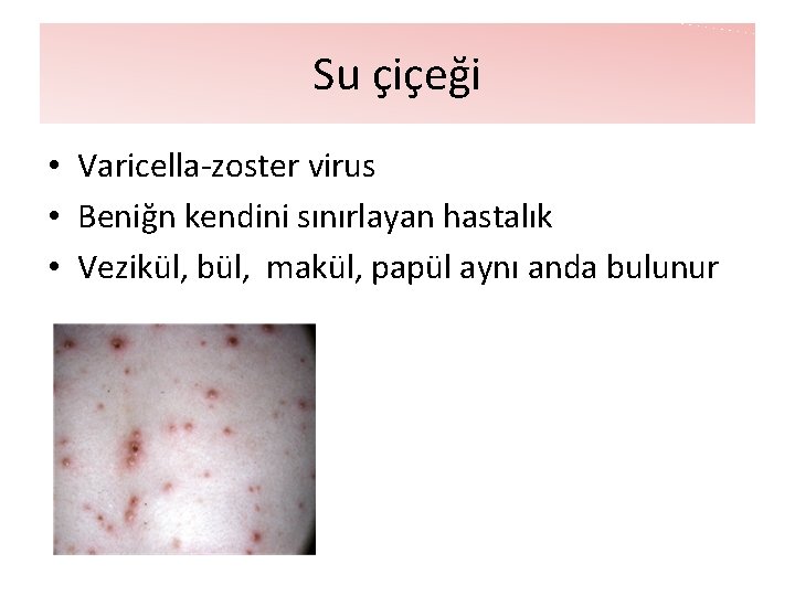 Su çiçeği • Varicella-zoster virus • Beniğn kendini sınırlayan hastalık • Vezikül, bül, makül, Su çiçeği • Varicella-zoster virus • Beniğn kendini sınırlayan hastalık • Vezikül, bül, makül,
