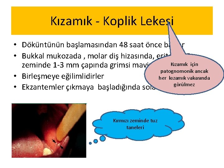 Kızamık - Koplik Lekesi • Döküntünün başlamasından 48 saat önce başlar • Bukkal mukozada Kızamık - Koplik Lekesi • Döküntünün başlamasından 48 saat önce başlar • Bukkal mukozada