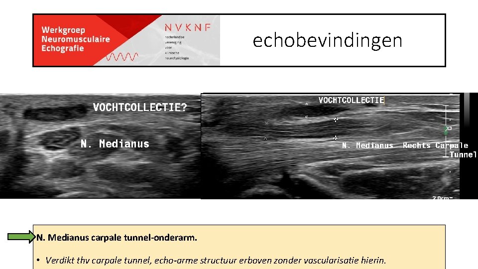echobevindingen N. Medianus carpale tunnel-onderarm. • Verdikt thv carpale tunnel, echo-arme structuur erboven zonder