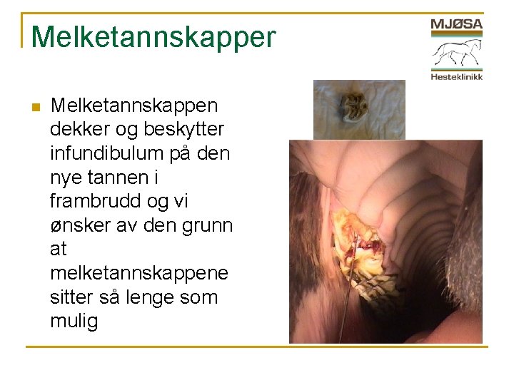 Melketannskapper n Melketannskappen dekker og beskytter infundibulum på den nye tannen i frambrudd og