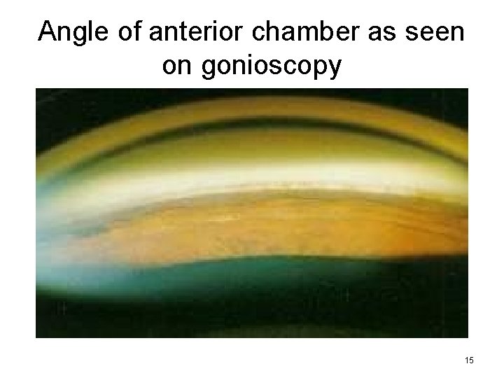 Angle of anterior chamber as seen on gonioscopy 15 