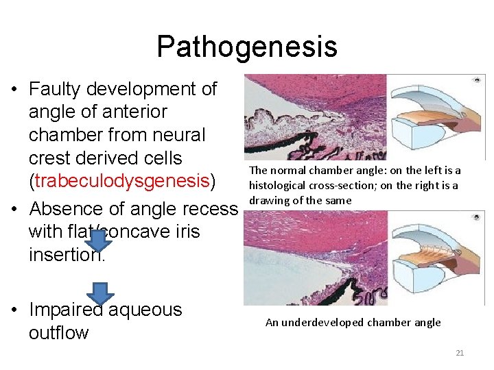 Pathogenesis • Faulty development of angle of anterior chamber from neural crest derived cells