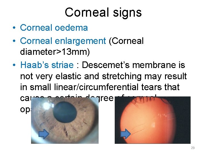 Corneal signs • Corneal oedema • Corneal enlargement (Corneal diameter>13 mm) • Haab’s striae