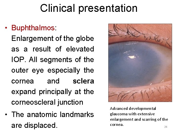 Clinical presentation • Buphthalmos: Enlargement of the globe as a result of elevated IOP.