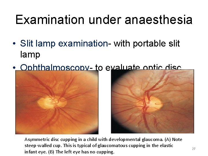 Examination under anaesthesia • Slit lamp examination- with portable slit lamp • Ophthalmoscopy- to
