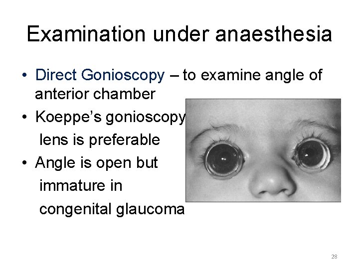 Examination under anaesthesia • Direct Gonioscopy – to examine angle of anterior chamber •
