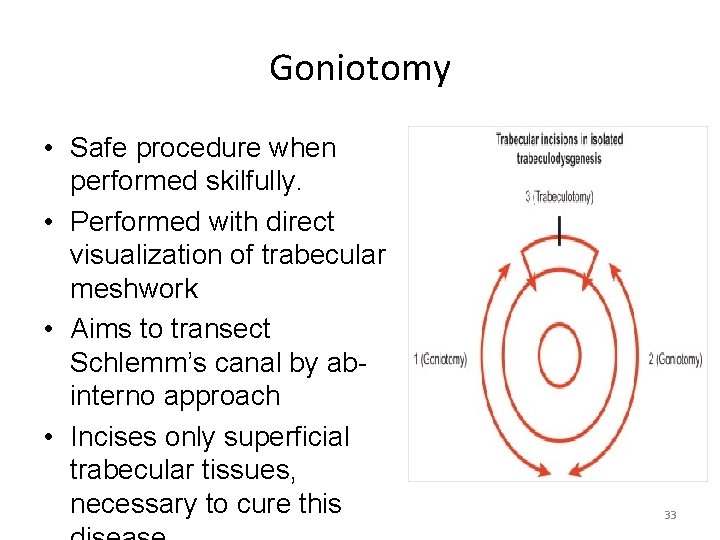 Goniotomy • Safe procedure when performed skilfully. • Performed with direct visualization of trabecular