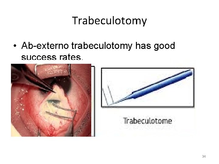 Trabeculotomy • Ab-externo trabeculotomy has good success rates. 34 