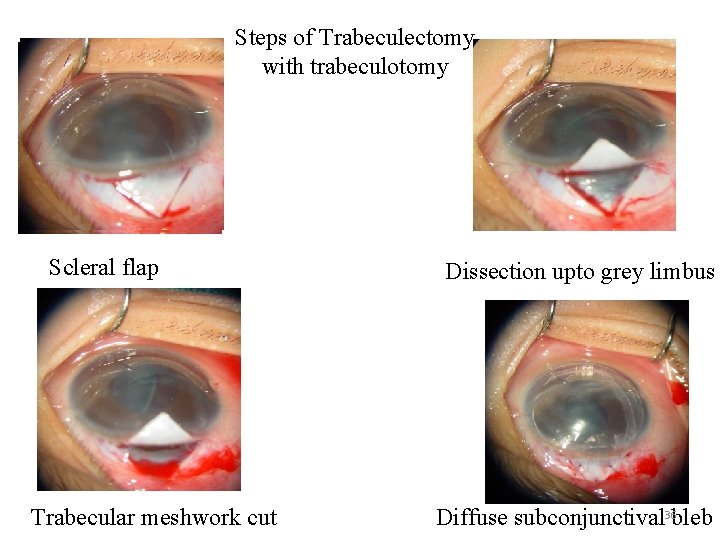 Steps of Trabeculectomy with trabeculotomy Scleral flap Trabecular meshwork cut Ds s. Dissection upto